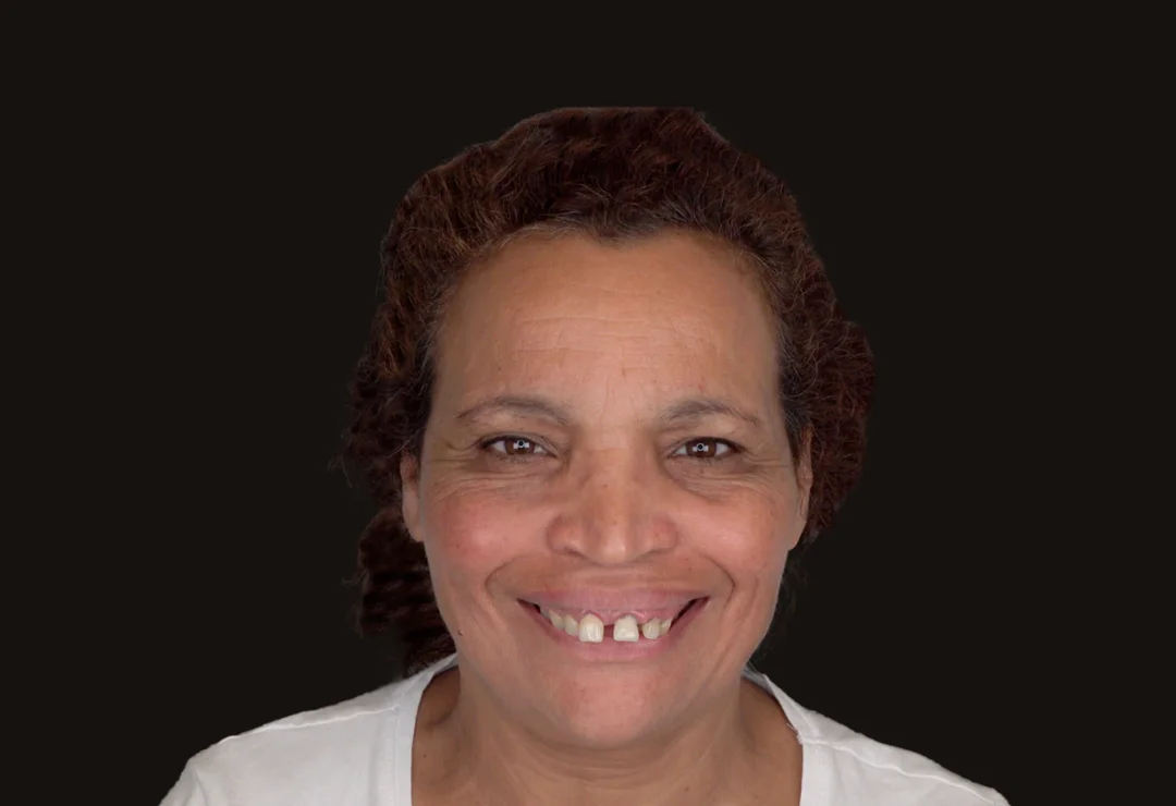 Implantes Dentales - Rabea 3 Implantes Dentales - Rabea 3