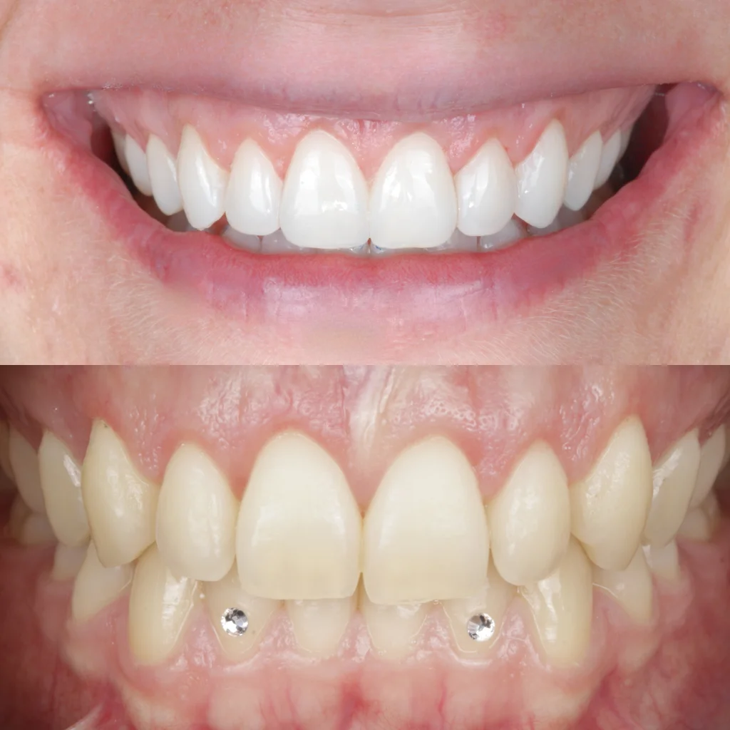 Carillas de Composite - Miriam 2 Carillas de Composite - Miriam 2