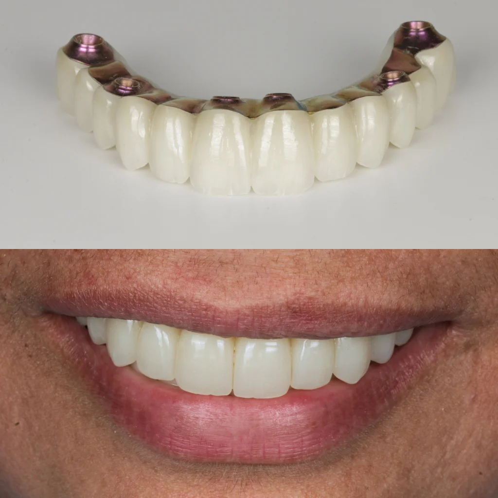 Implantes Dentales - Rabea 2 Implantes Dentales - Rabea 2