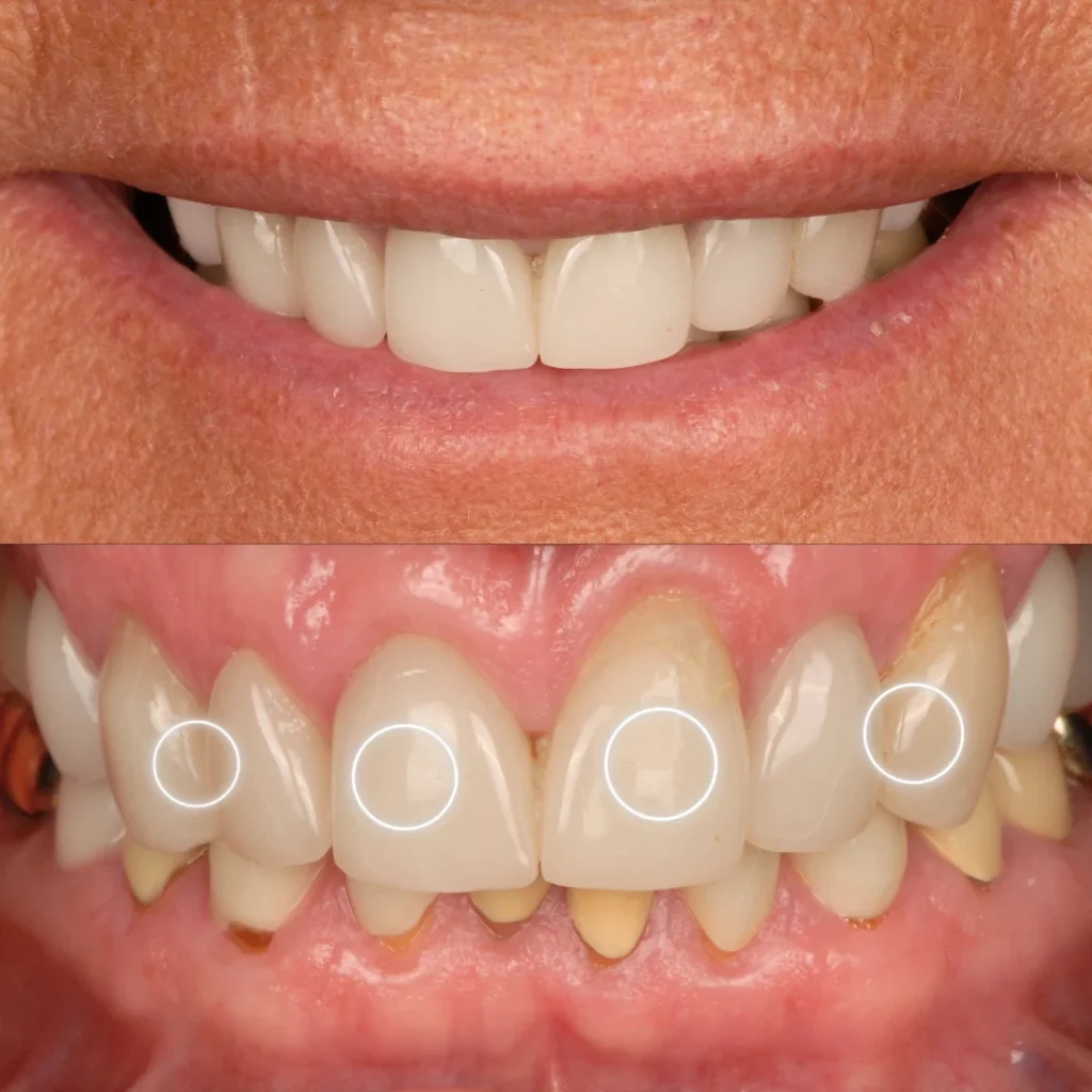 Carillas de Porcelana - Angelique 1 Carillas de Porcelana - Angelique 1