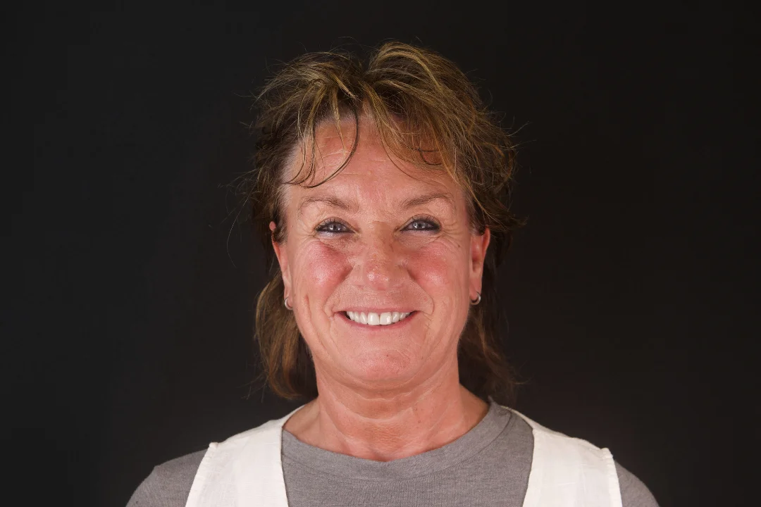 Carillas de Porcelana - Angelique 3 Carillas de Porcelana - Angelique 3