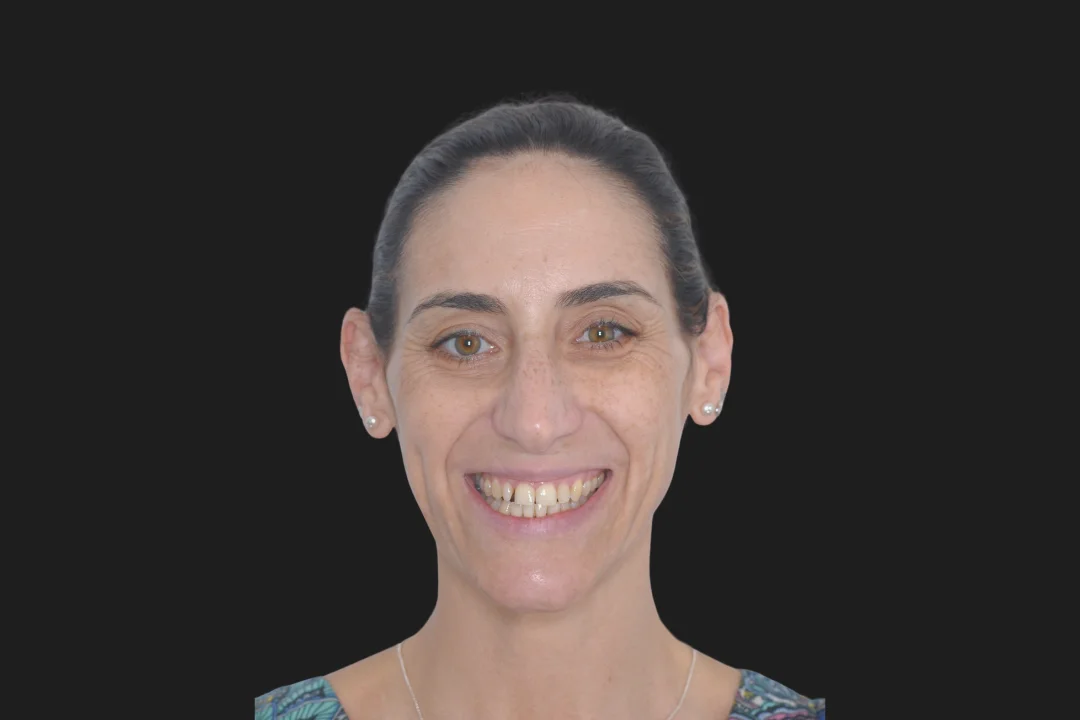 Carillas de Composite - Rocío 3 Carillas de Composite - Rocío 3