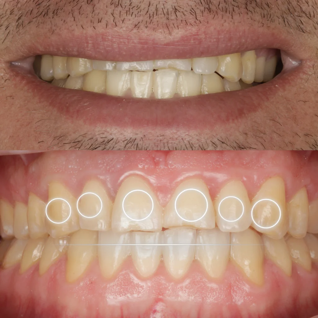 Carillas de Porcelana - José 1 Carillas de Porcelana - José 1