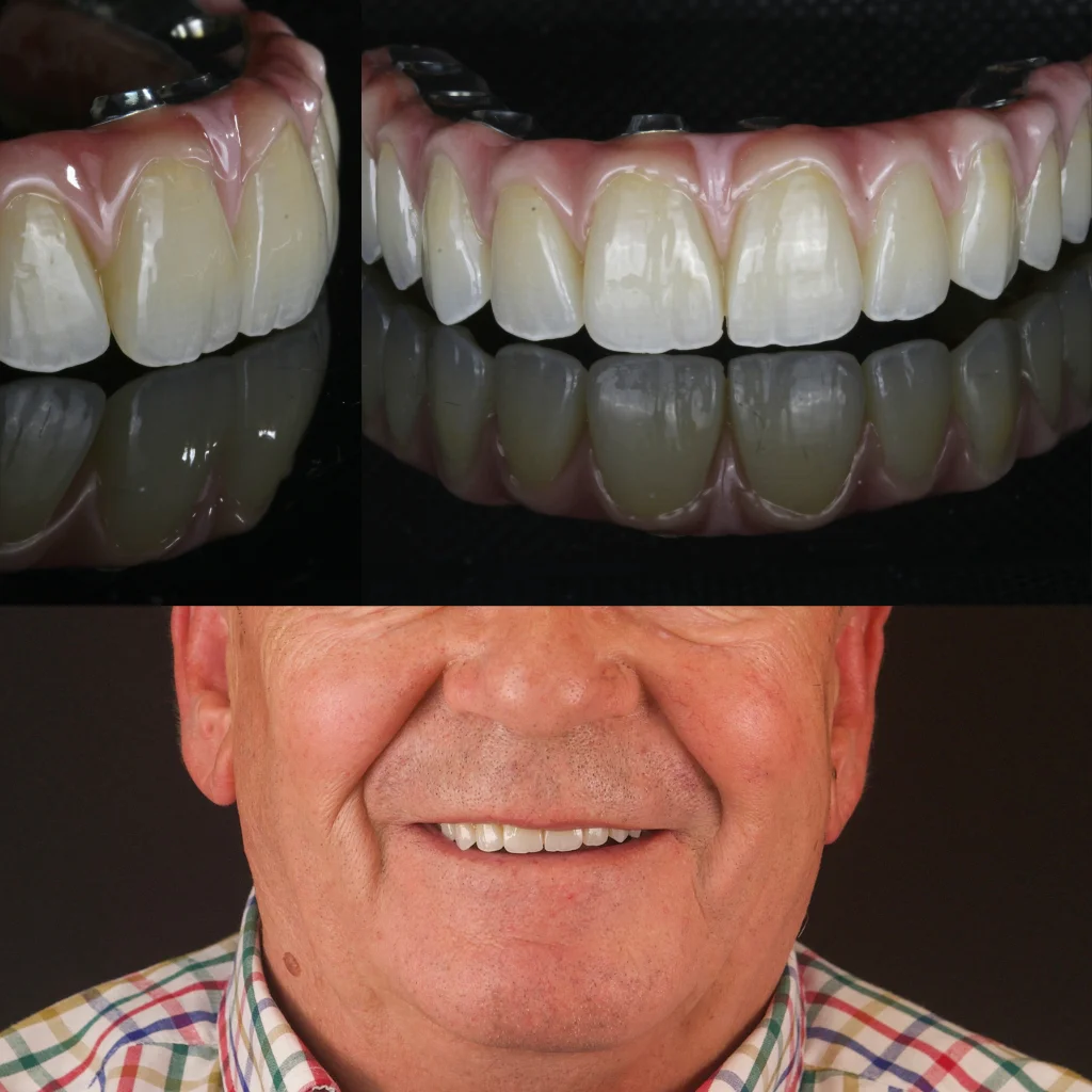 Implantes Dentales - Luis 2 Implantes Dentales - Luis 2