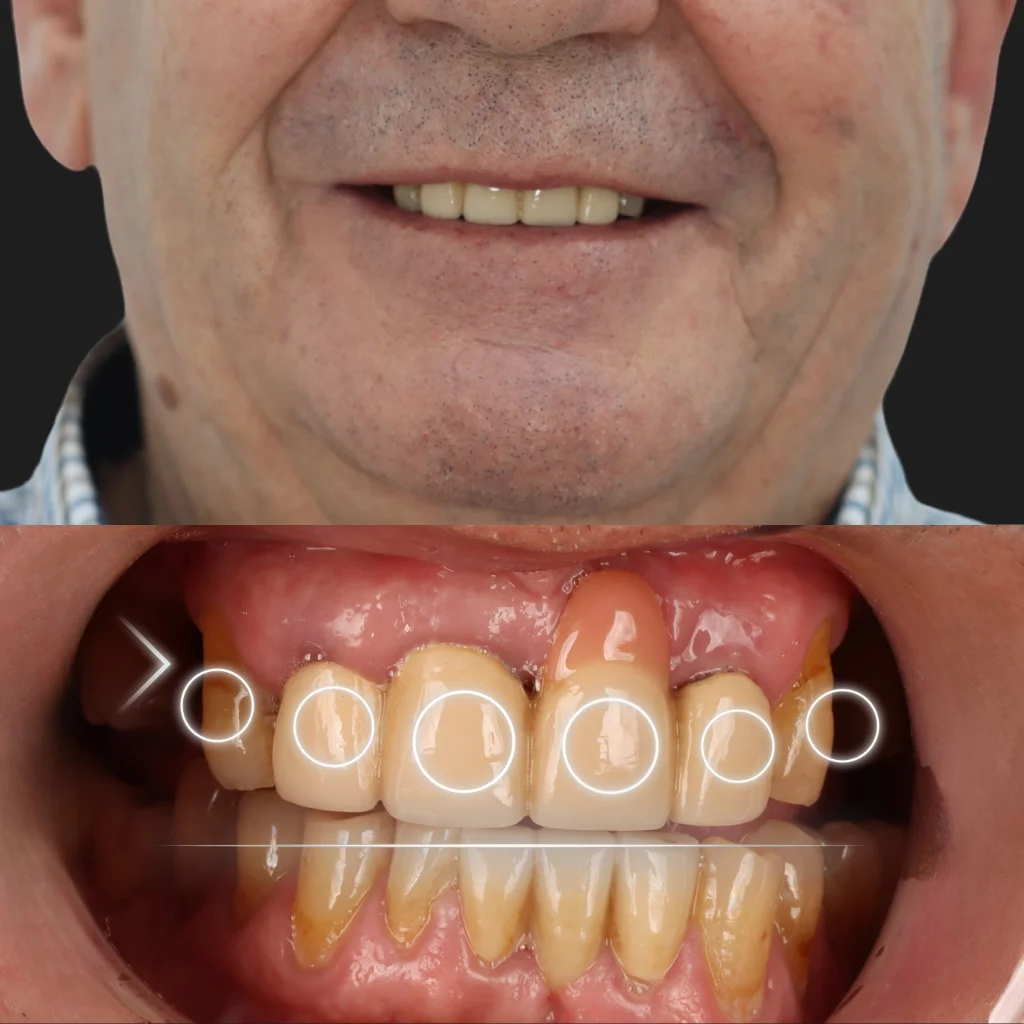 Implantes Dentales - Luis 1 Implantes Dentales - Luis 1