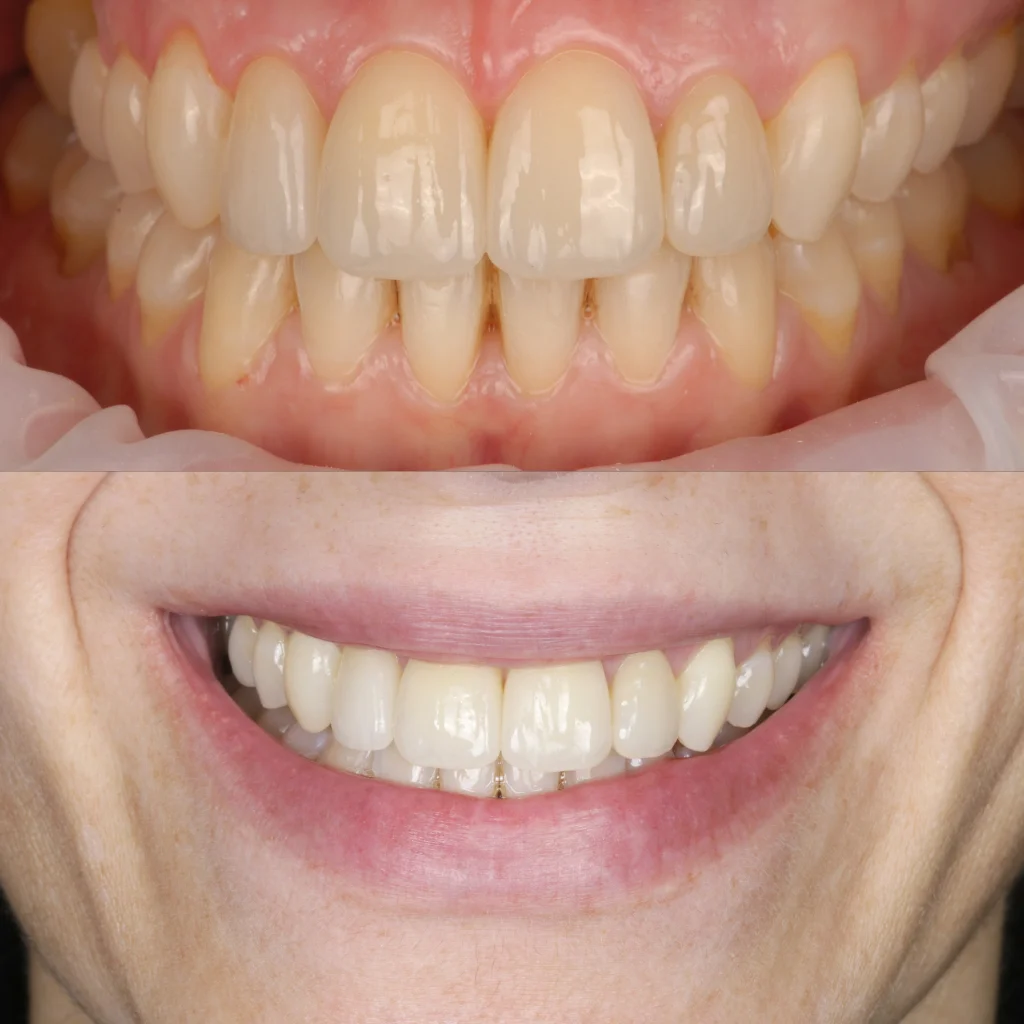 Carillas de Composite - Rocío 2 Carillas de Composite - Rocío 2