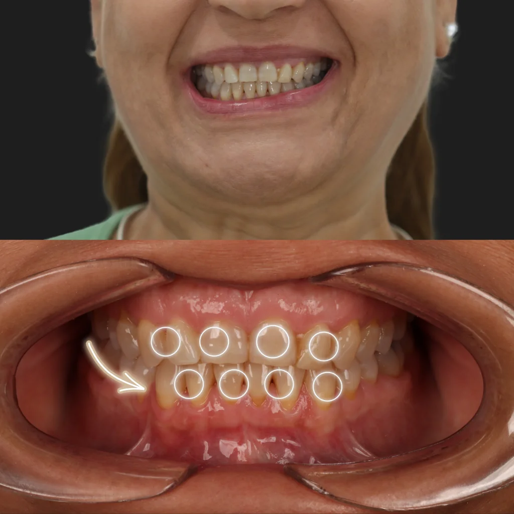 Carillas de Porcelana - Sonia 1 Carillas de Porcelana - Sonia 1