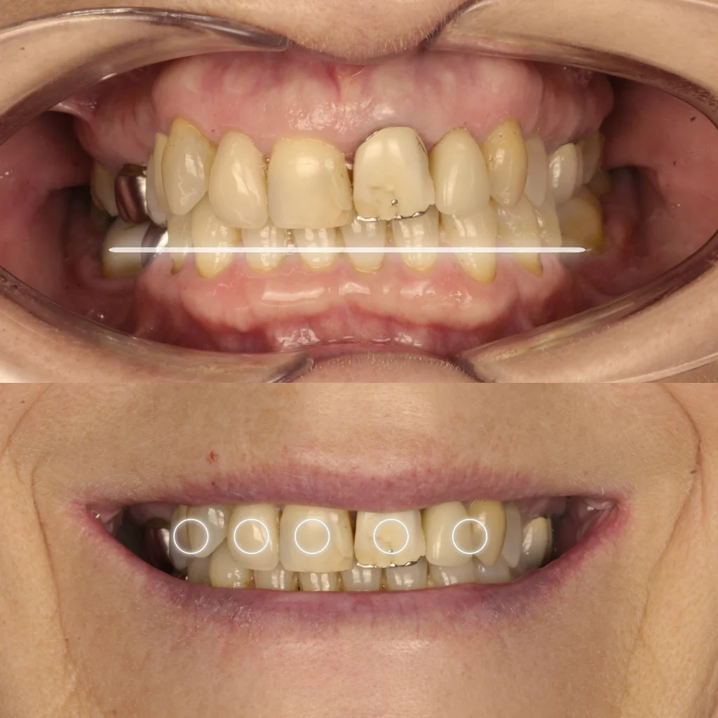 Carillas Dentales - Carole 1