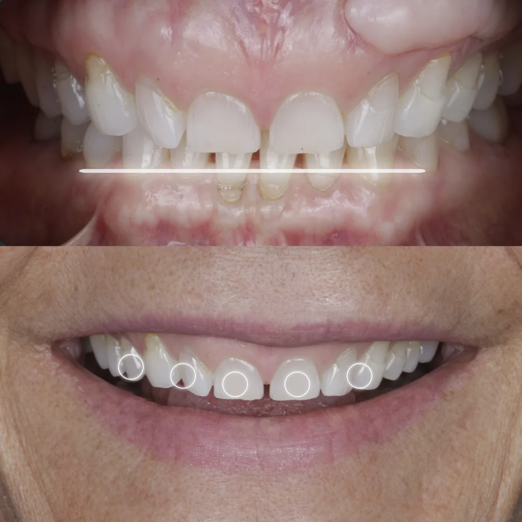 Carillas Dentales - Edith 1