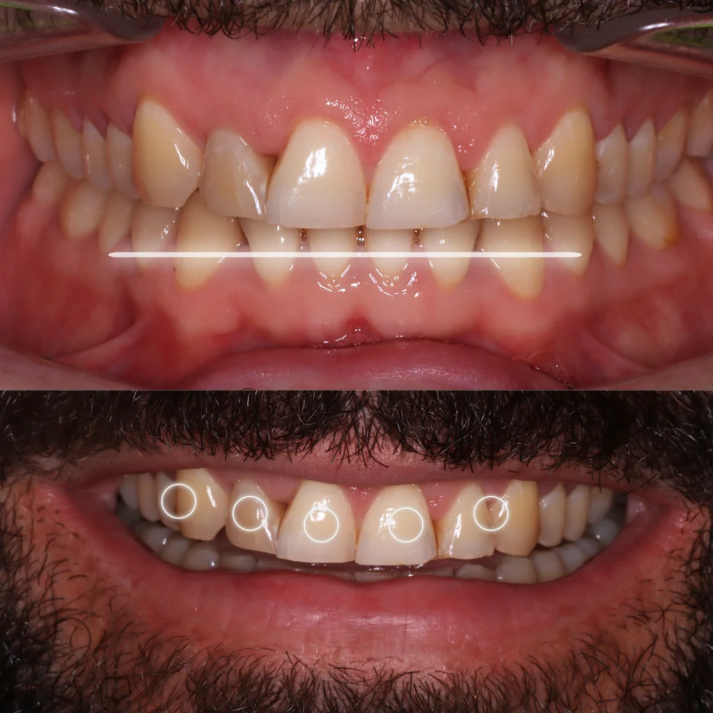 Carillas Dentales - Jairo 1