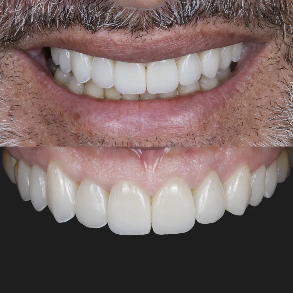 Carillas Dentales - Jerónimo 2