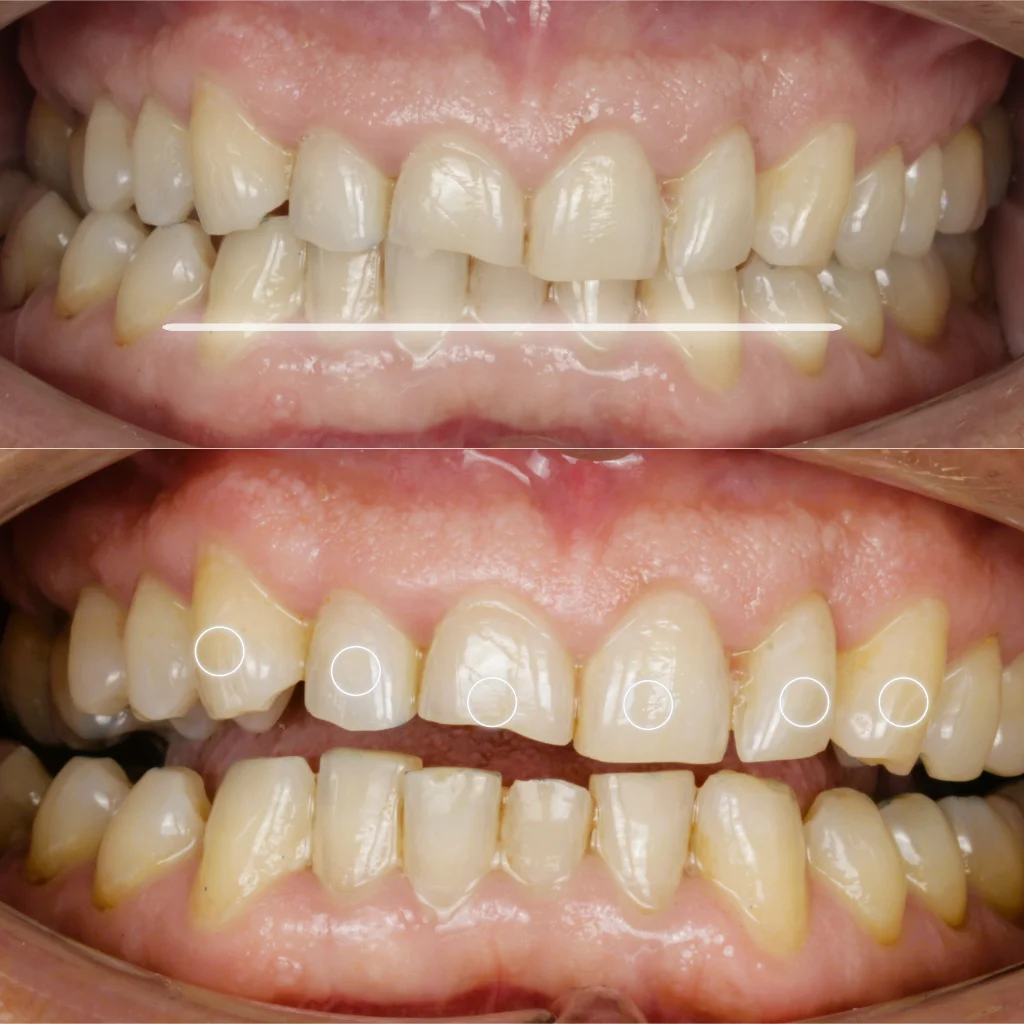 Carillas Dentales - Jerónimo 1