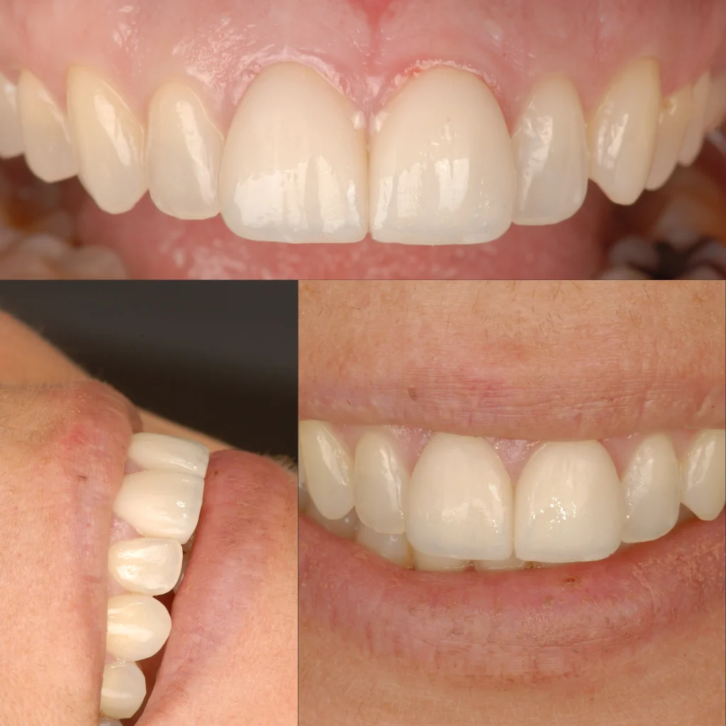 Carillas Dentales - María Isabel 2