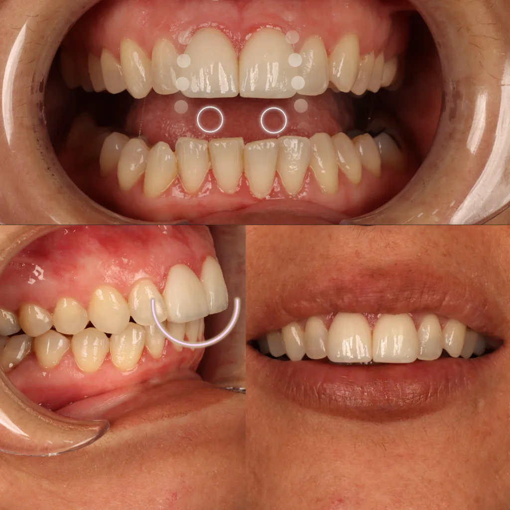 Carillas Dentales - María Isabel 1